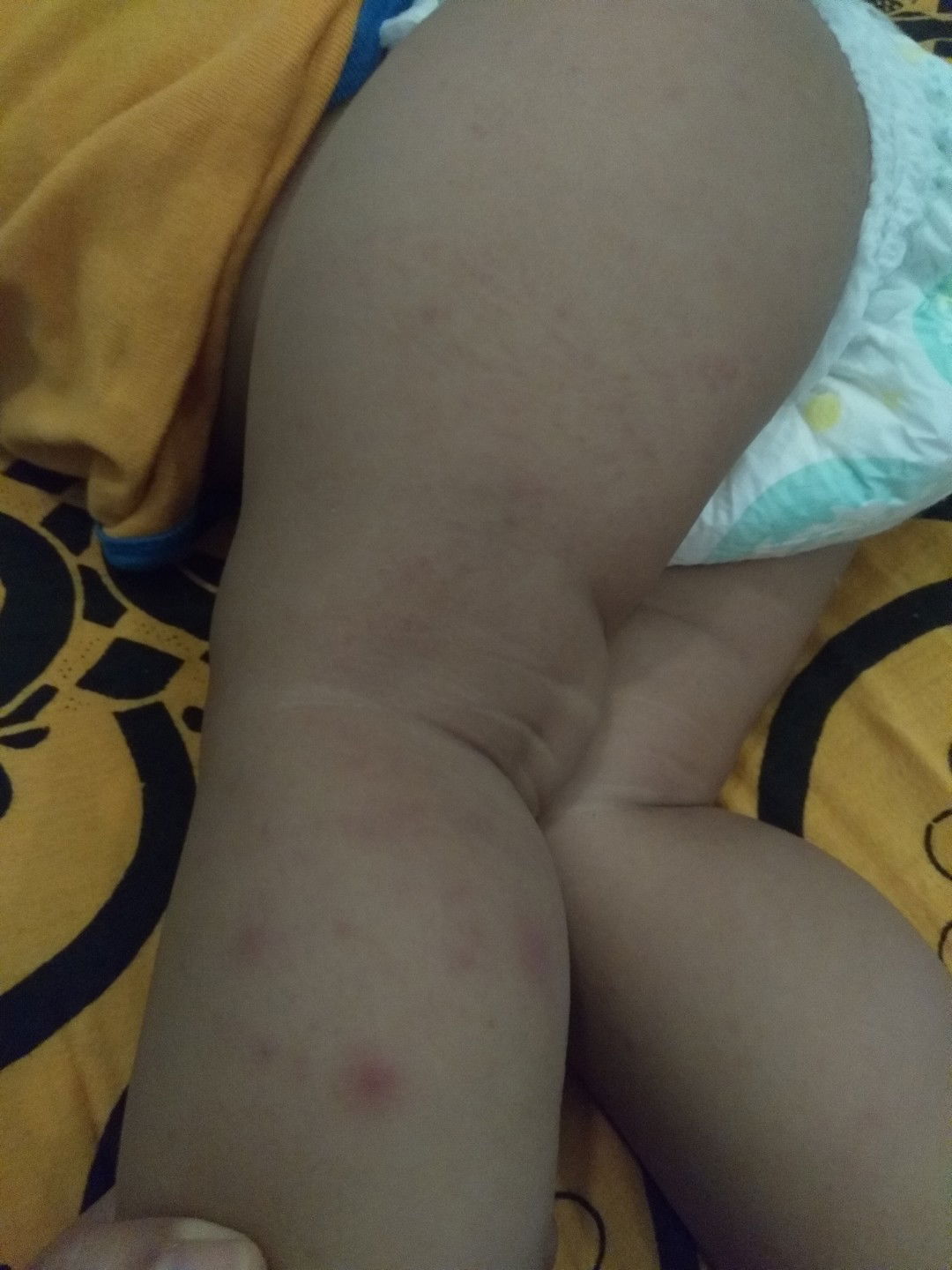 merah merah pada bayi