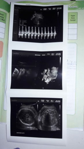 Usia Plasenta lebih tua dibanding Janin