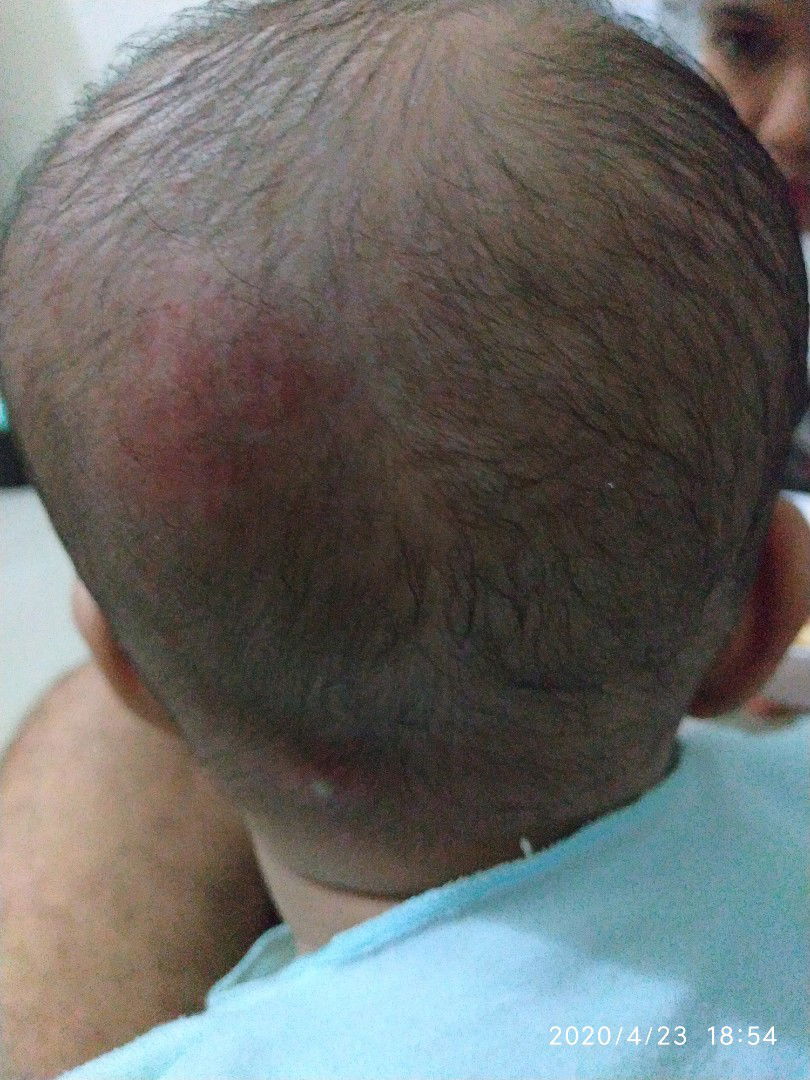 Ruam merah di Kepala