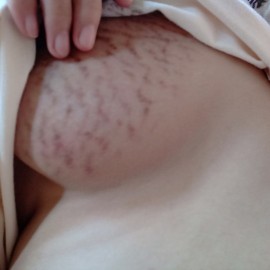 STRETCHMARK