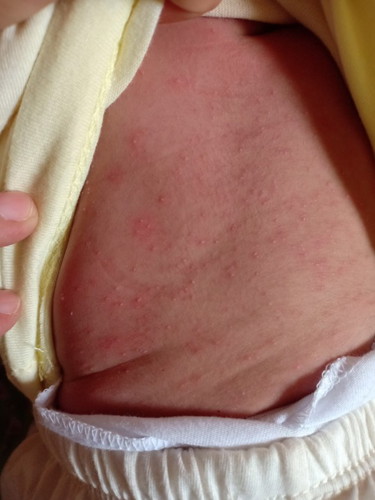 rashes or allergy