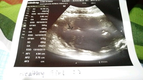 baby gender