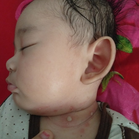 gatal