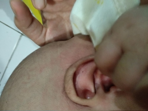 Rambut halus dibagian daun telinga