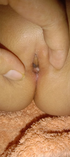 Kelainan pada kelamin bayi