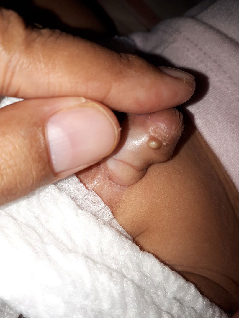 mau nanya soal kemaluan bayi laki laki