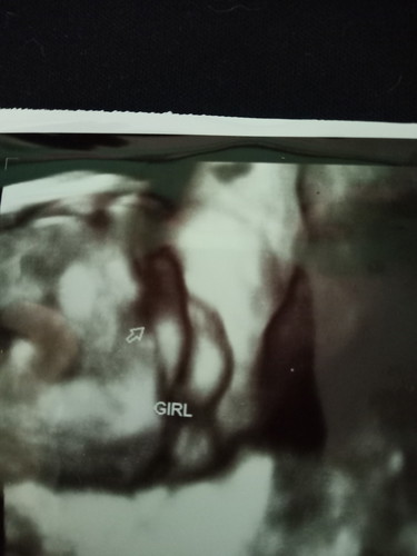 bby 32week