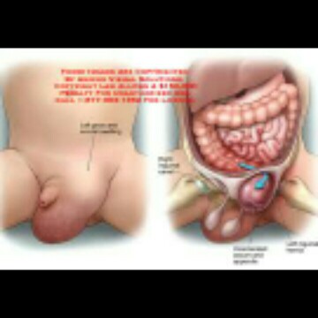 Pengalaman Anak Hernia Inguinalis