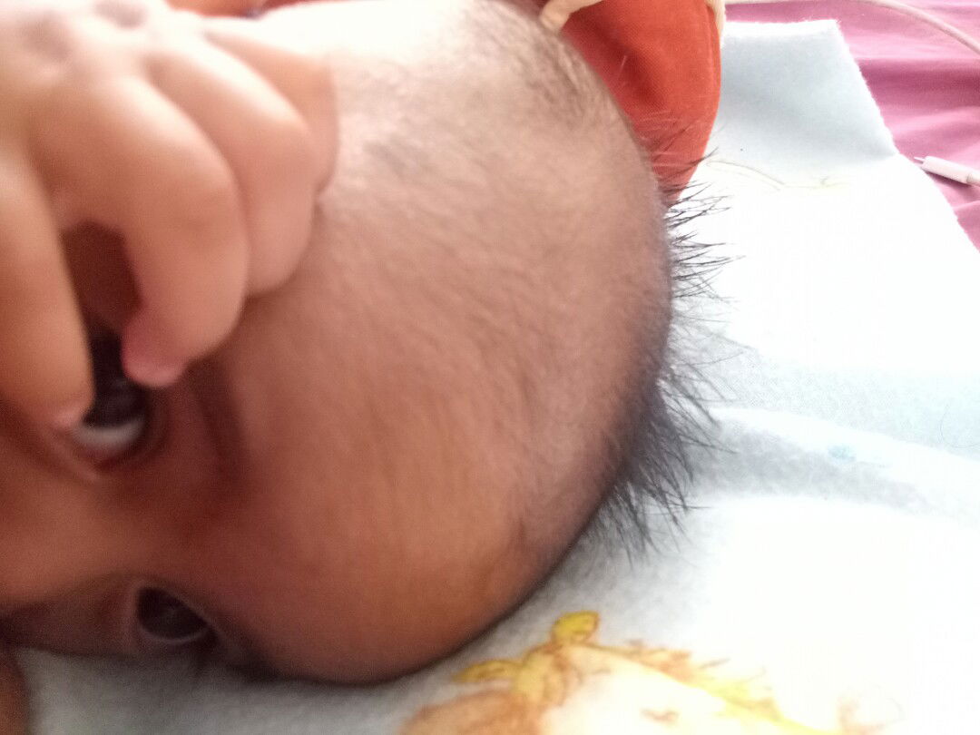 Tumbuh Rambut Tidak Rata