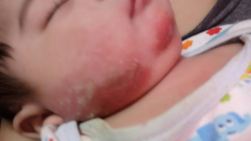Atopic Dermatitis