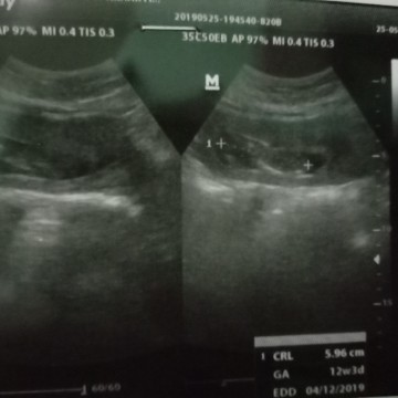 usg bayi