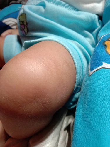 pada kulit bayi