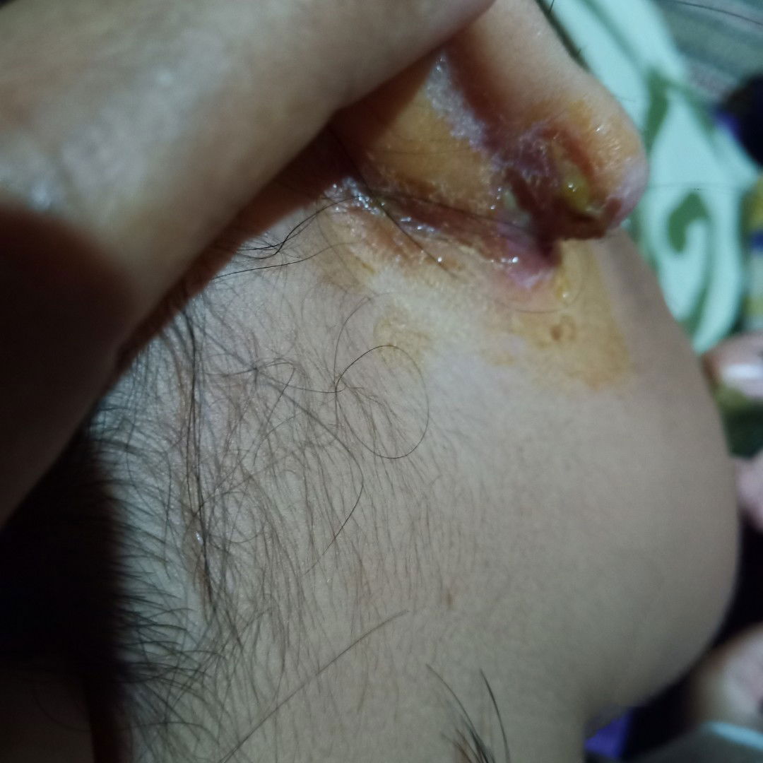 ada yang tau salep gatal ber air kayak gini.telinga siku anak saya yg besar umur 8 tahun