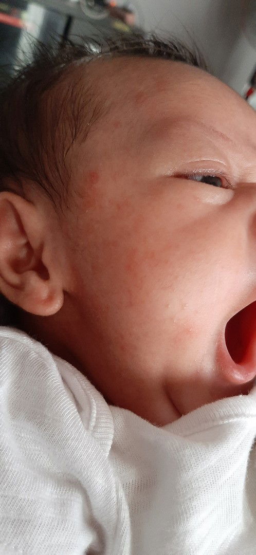 Merah pada kulit bayi