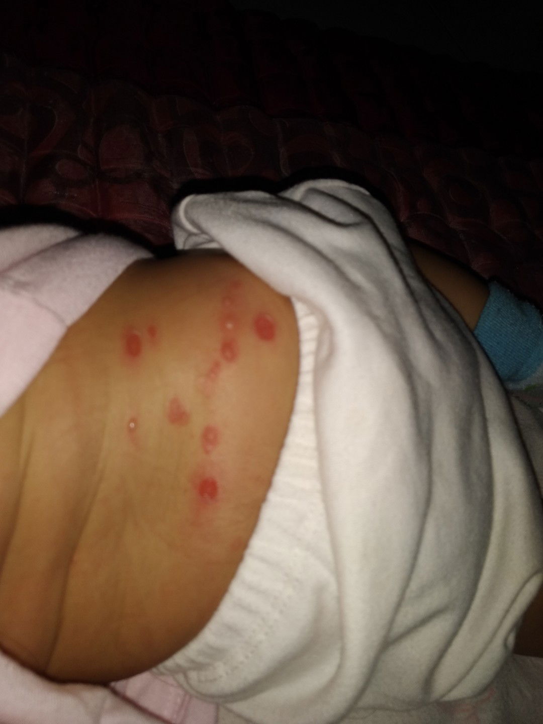 Bentol2 berair di kulit bayi