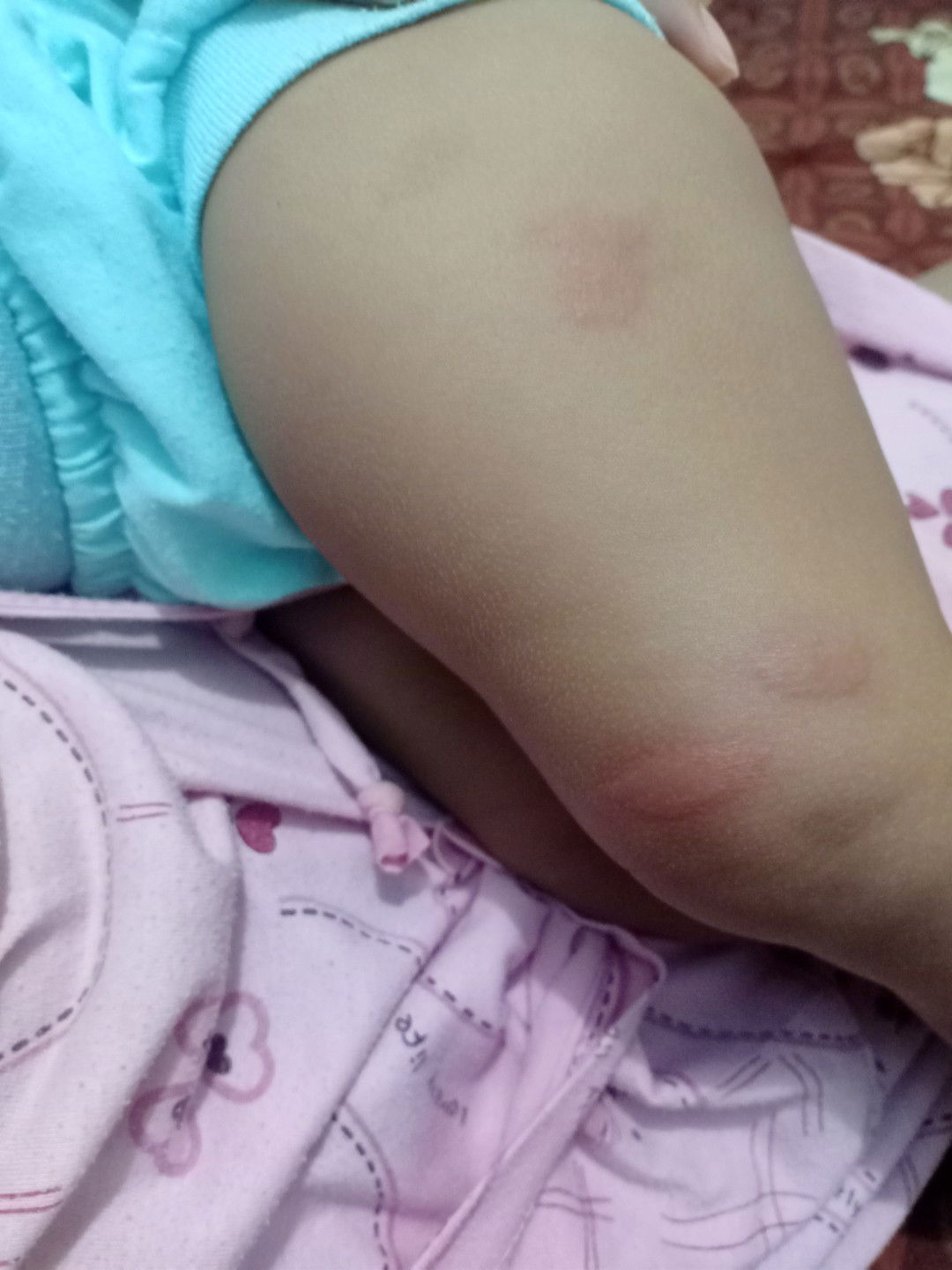 gigitan nyamuk apa bukan?