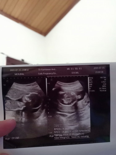 hasil USG Kehamilan 18-19 week