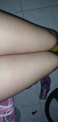 Rashes Sa Legs