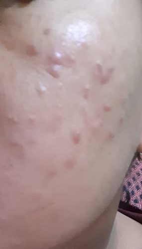 ada nggak yg masa hamil jerawatan bunda