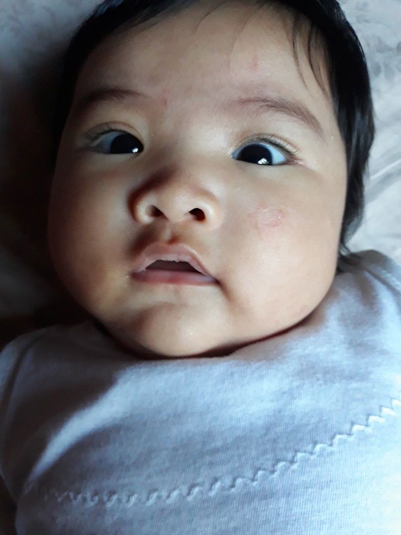 baby rash or eczema?