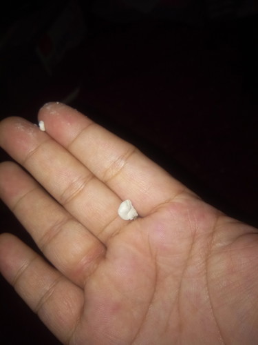 Pagkirot ng Balakang