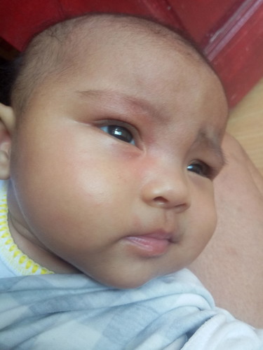 Kulay Pula sa Mukha ni Baby