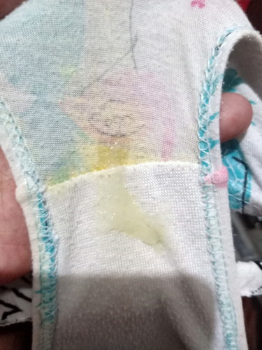 MUCUS or NORMAL DISCHARGE?
