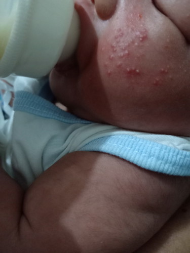 baby acne