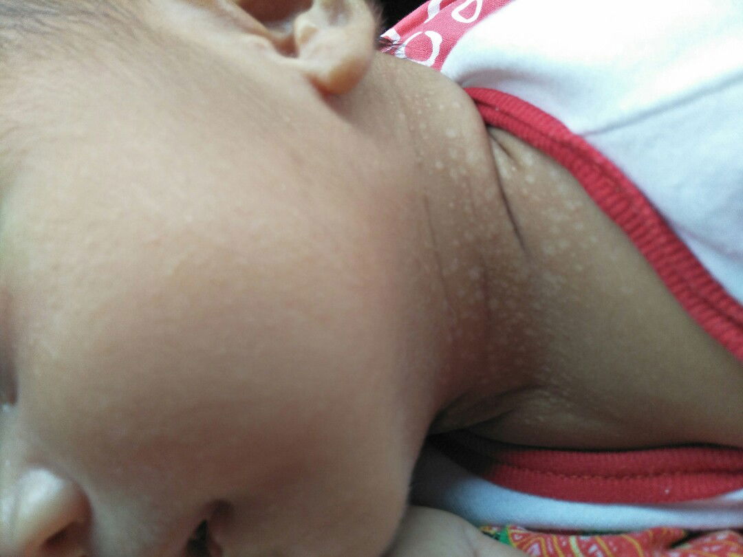 bintik2 putih di leher