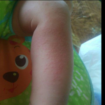 alergi / biang kringat?