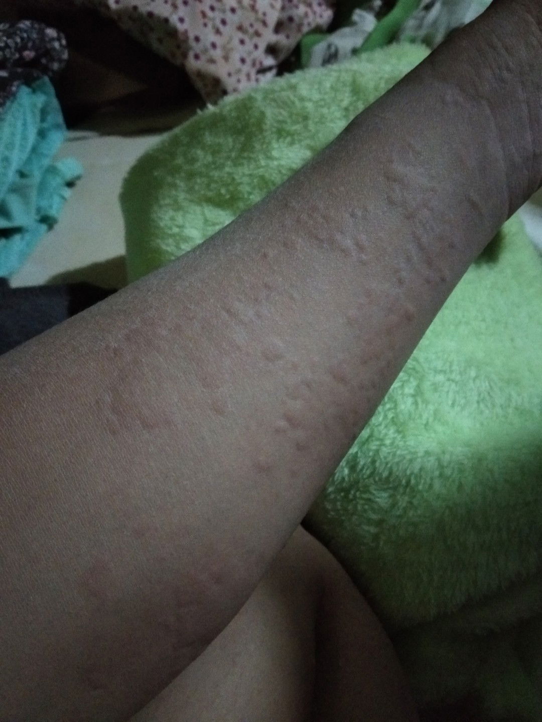 obat biduran yang paling manjur