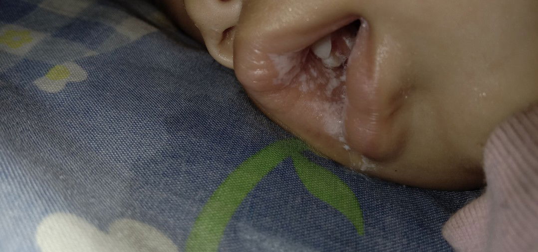 Putih putih pada mulut bayi
