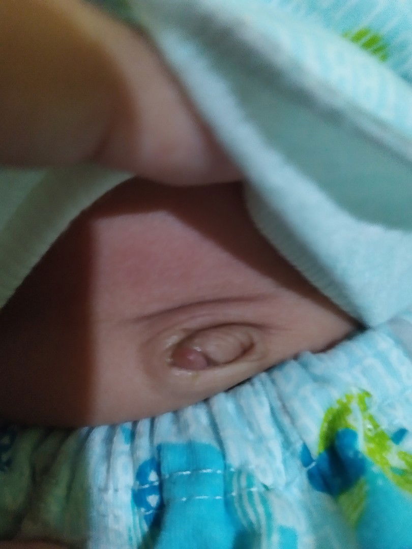 Daging tumbuh di pusar