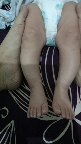 kaki bentuk O