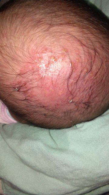 ruam merah dikepala,obat nya apa ya bunda..share dong