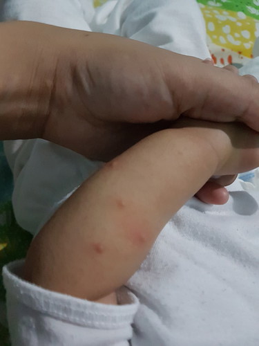 mosquito bite