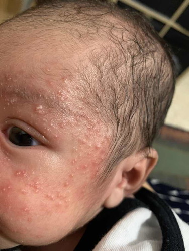 Skin conditions