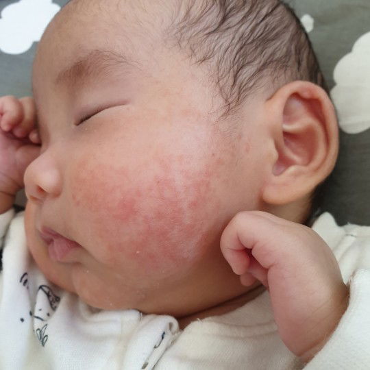 Redness on my baby's face