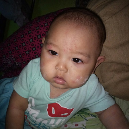 Ruam-ruam bayi