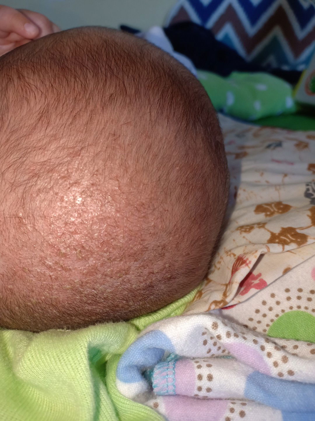 Kerak di kepala bayi