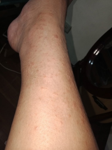 RASHES
