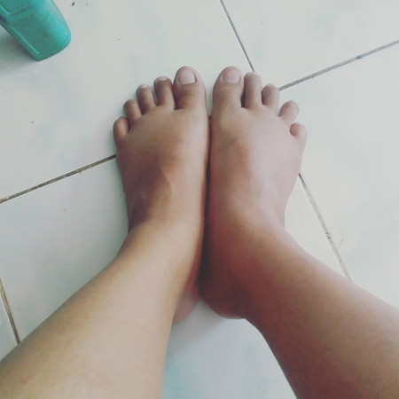 kaki bengkak