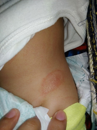 Diaper Rash?