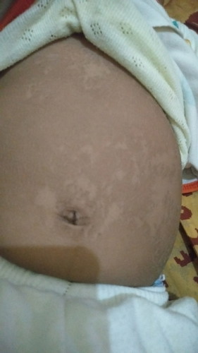 maaf bunda" mau tanya adakah yang anaknya pernah ngalamin kaya gini? kira" gpp ngk ya sedih aku liatnya, pas mandi mau aku gosok" tapi anaknya ngk mau...tolong dibntu jawab ya bunda bunda....