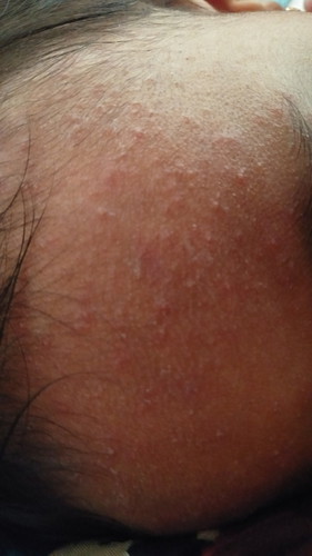 assalamualaikum bunda" minta masukannya dong ini anak saya keningnya pada brutusan kadang laya ada nanahnya udah dipriksa keklinik dikasih salep cuma ada lagi dan lagi mungki bunda" ada yang pernah ngalamin anaknya bisa kasih masukan?? makasih sebelumnya