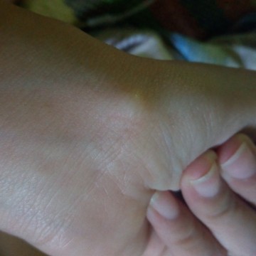 lump in wrist