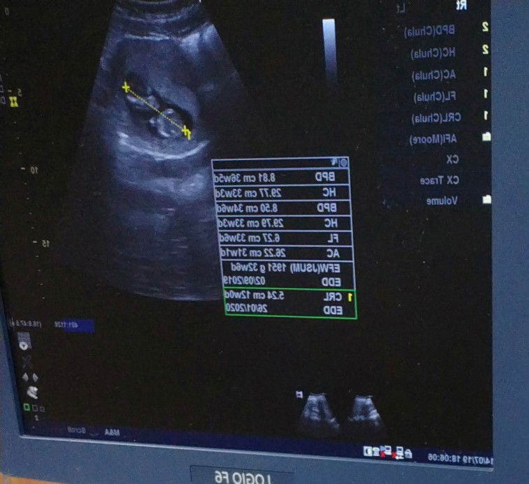 เลือดออกตอน3เดือน