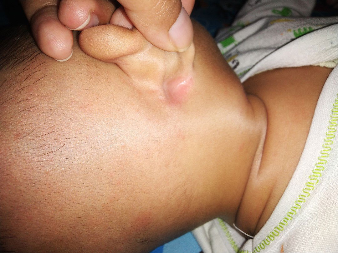 ruam merah dibelakang telinga