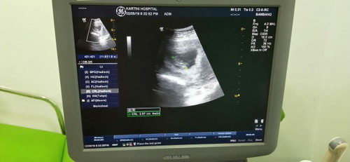 Baru ketahuan bayi ternyata kembar di minggu ke-20