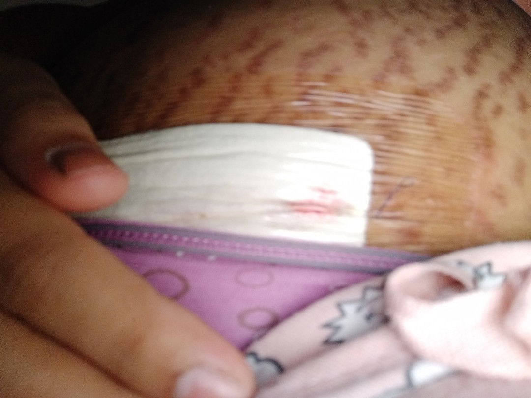 2 days after C-section